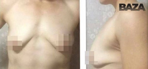 Пациентка требует у уфимской клиники 10 млн рублей за изуродованную грудь