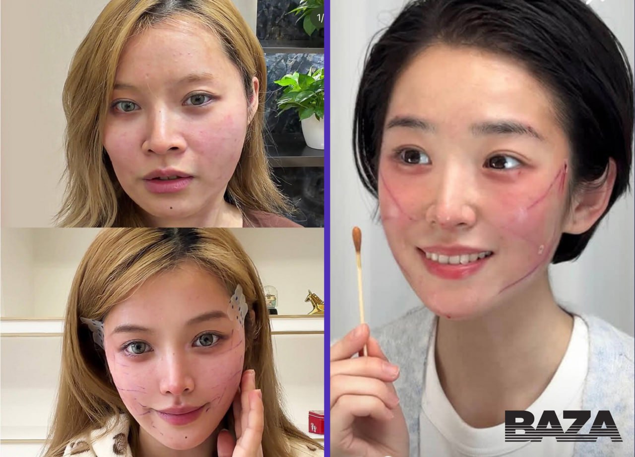 Китайская «карательная» пластика покалечила россиянок — они повелись на рекламу «До/После», где из обычных девушек делают кукол Китайская «карательная» пластика покалечила россиянок — они повелись на рекламу «До/После», где из обычных девушек делают кукол