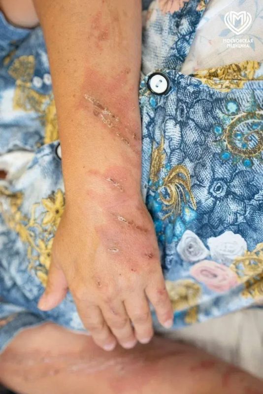 Москвичка попала в больницу с ожогами после отдыха на юге России Москвичка попала в больницу с ожогами после отдыха на юге России