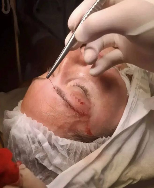 В Крымске из века пациентки достали паразита В Крымске из века пациентки достали паразита